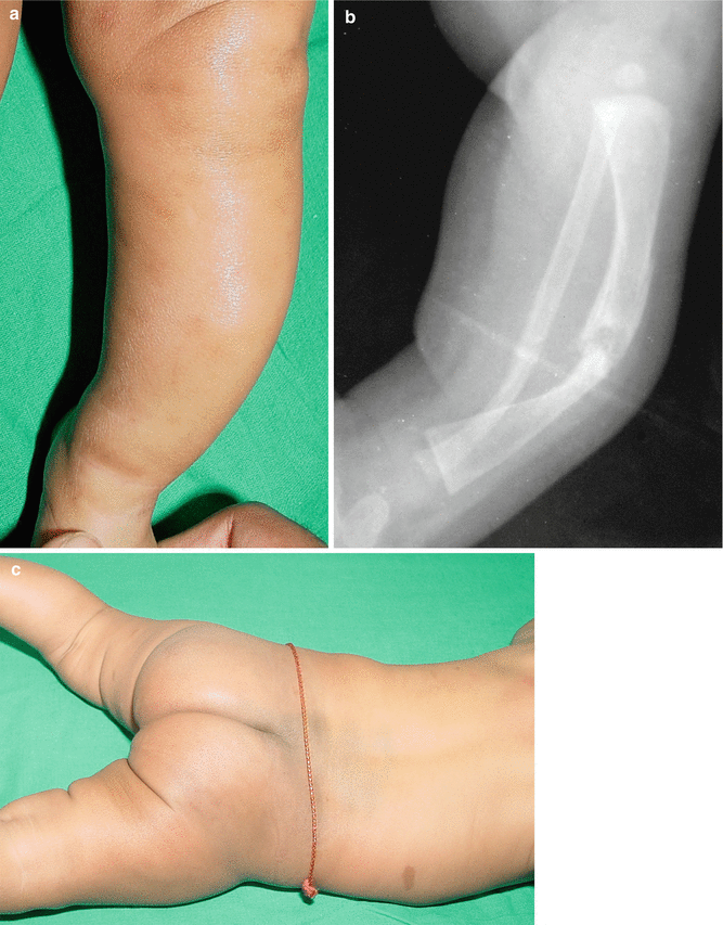 An unusual form of congenital anterolateral tibial angulation—the delta  tibia