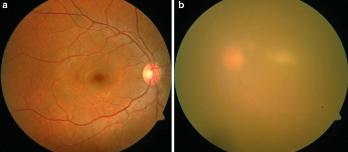 Toxoplasma Retinochoroiditis | SpringerLink