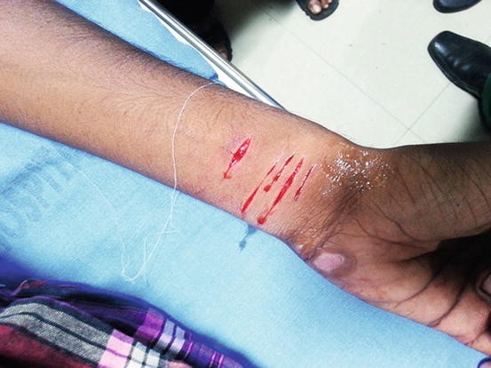 Deliberate Self-Harm | SpringerLink
