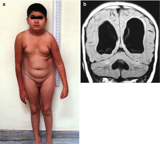 pediatric nude photos  puberty developmentnude family photography Daughterpedomom  boys  file 01 Disorders of Growth and Development: Clinical Perspectives | SpringerLink