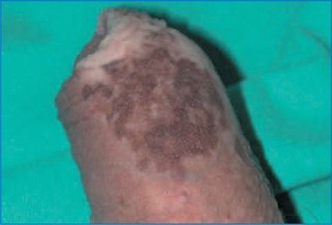 Pigmentation Disorders | Springer Nature Link