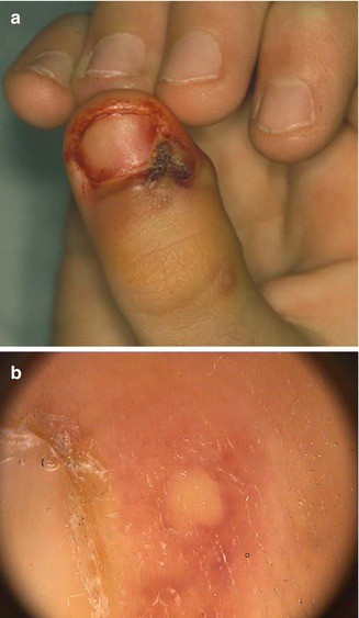 Infective Nail Disorders | SpringerLink Infective Nail Disorders | SpringerLink