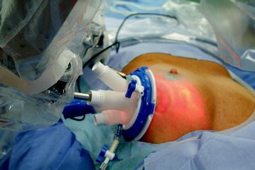 History of the Mini-Invasive Video Assisted Breast Surgery: From East to  West