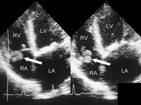 Medische Isothermische Ampul - Keperbinding Thermische Fles Voor Medicatie