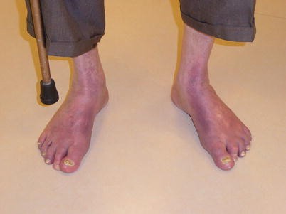 De diabetische voet en perifeer arterieel vaatlijden | SpringerLink