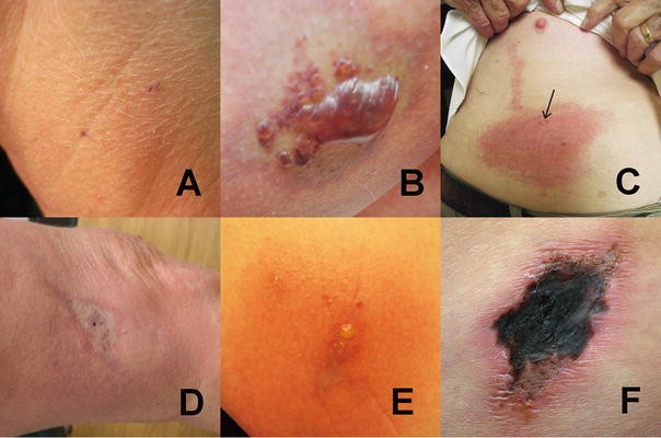 Figure 2 from Rare case of dermonecrosis caused by a recluse spider bite in  Europe