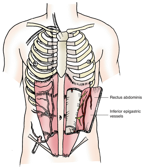 Deep Inferior Epigastric Artery Perforator (DIEP) Flap | SpringerLink