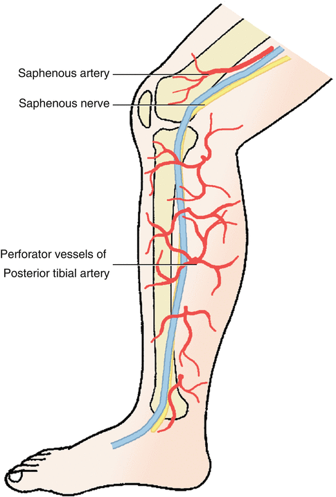 Posterior Tibial Artery Perforator Flap | SpringerLink