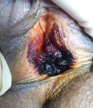 Excision of Vaginal and Vulvar Cysts