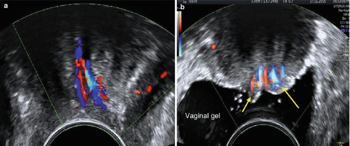 Ultrasound Evaluation of the Cervix