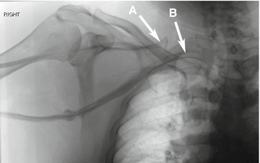 Angle of Louis, transverse thoracic plane, with radiograph! (anatomy) 