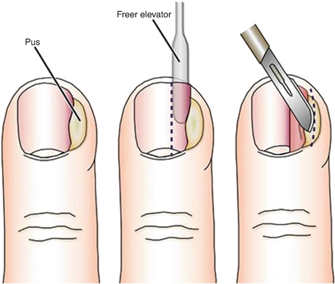 Infection: Paronychia - nail fold infections
