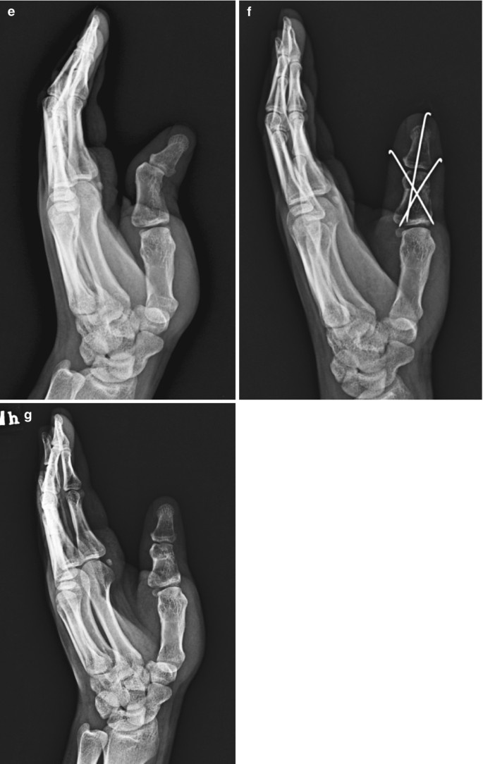 Long-term results following osteotomy of the thumb delta phalanx