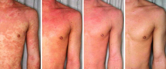 Red Skin Syndrome | SpringerLink