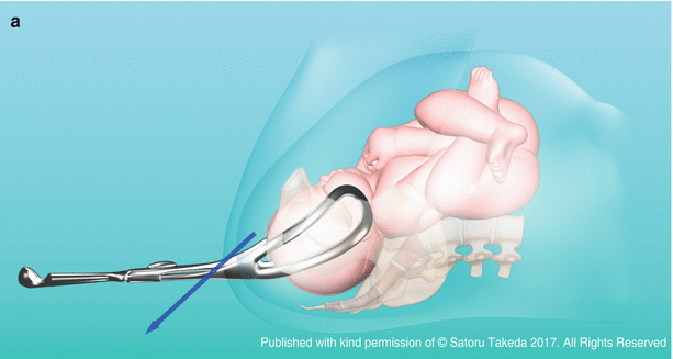 Techniques for the Forceps Procedure | SpringerLink Techniques for the Forceps Procedure | SpringerLink