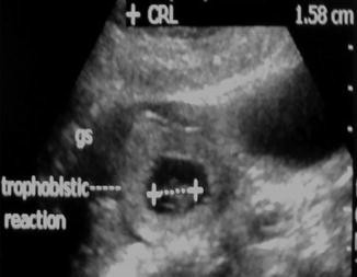 Obstetric Ultrasound | SpringerLink