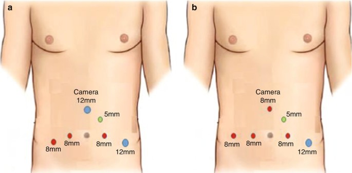 Ogden Umbilical & Belly Button Hernia Treatment