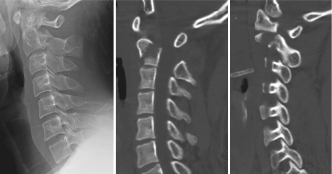 Spinal Injury | SpringerLink