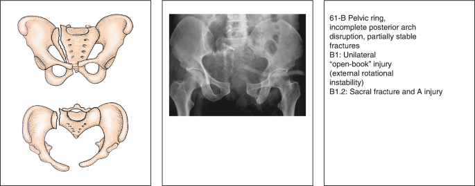 Open book pelvic injury, Radiology Reference Article