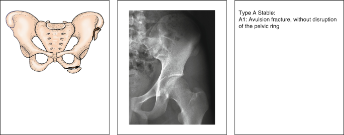 Classification of Pelvic Ring Fracture and Dislocation | SpringerLink