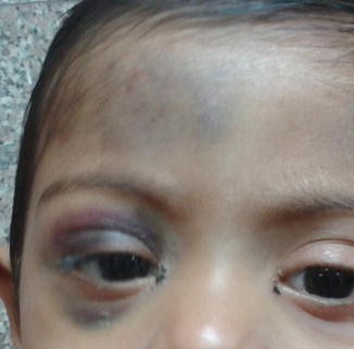 Pediatric Head Injury Springerlink