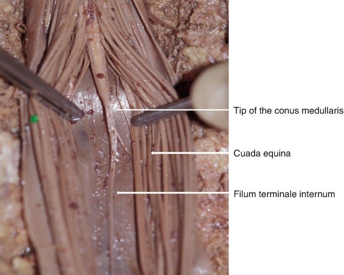 Cauda Equina Injuries | SpringerLink