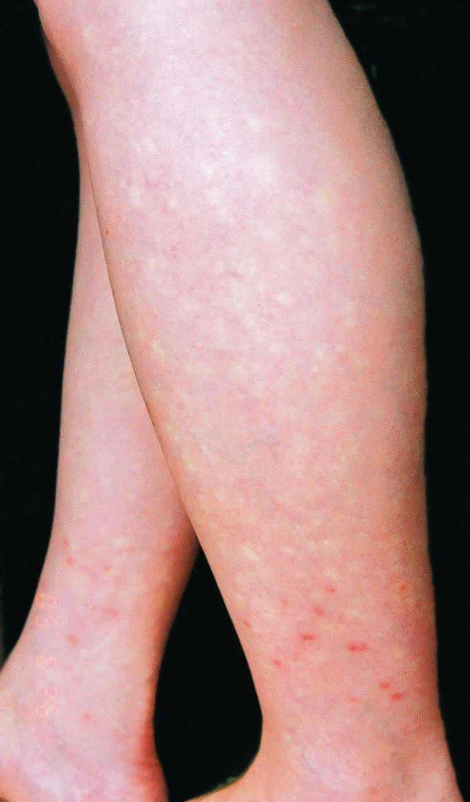 Non-inherited Cutaneous Syndromes | SpringerLink