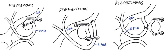 Surgery of Posterior Inferior Cerebellar Artery (PICA) Aneurysm