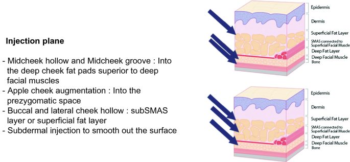 Filler Procedures Based on the Facial Area | SpringerLink