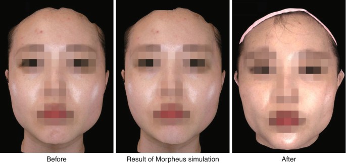 Evaluation Of The Outcomes Using Morpheus System Springerlink