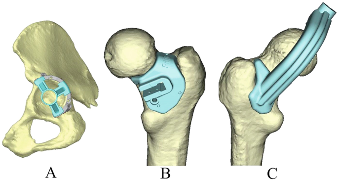 Patient-Specific Surgical Guide for Total Hip Arthroplasty