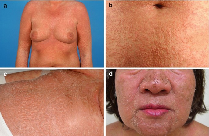 Drug Reaction with Eosinophilia and Systemic Symptoms (DRESS) | Springer Nature Link Drug Reaction with Eosinophilia and Systemic Symptoms (DRESS) | Springer Nature Link