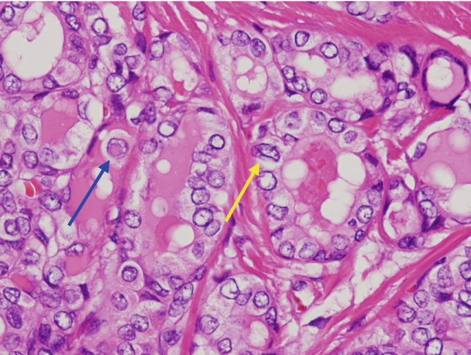 papillary carcinoma