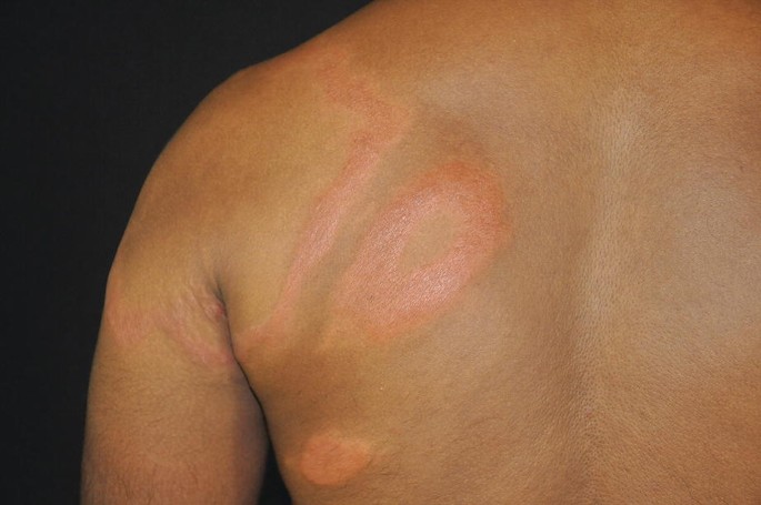 Thickening of skin and plaques on a man's nipples and areolas - Clinical  Advisor