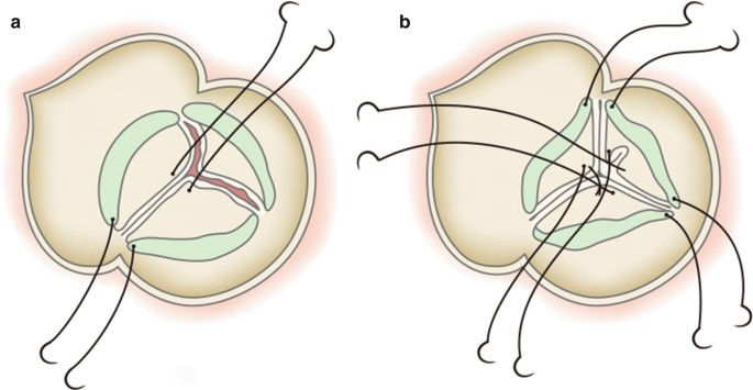 Aortic Valvuloplasty to Treat Aortic Regurgitation Accompanied by a  Ruptured Sinus of Valsalva Aneurysm | SpringerLink