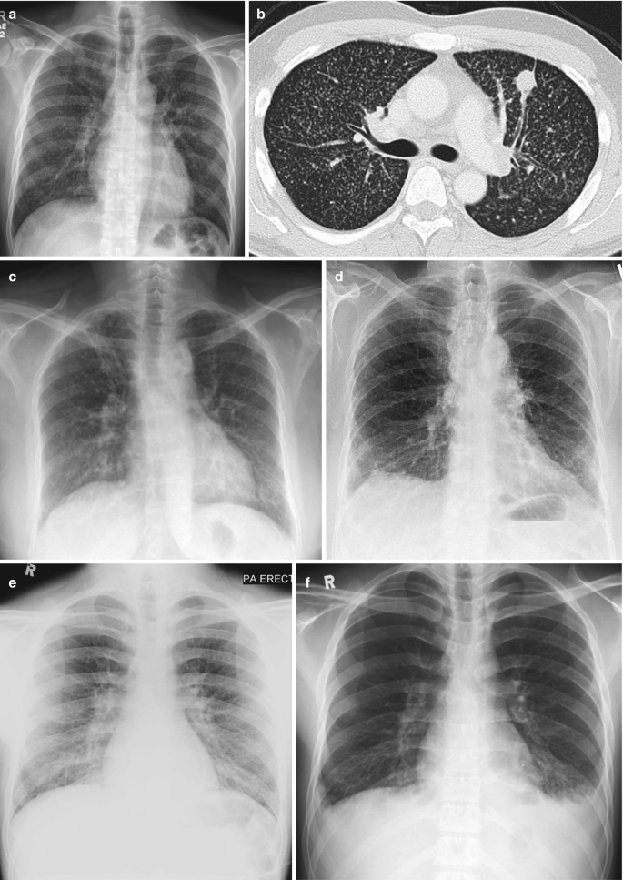 The role of imaging in the diagnosis of bronchiectasis: The key is in the  distribution - ScienceDirect