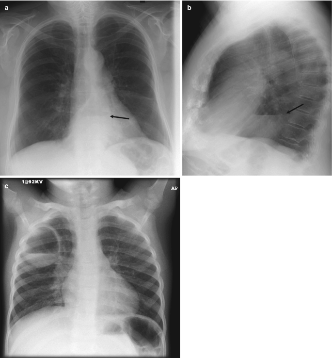 Respiratory medicine: bronchiectasis | RCP Journals
