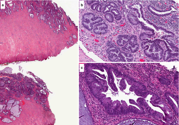 Glandular Neoplasia of the Uterine Cervix and Its Related Lesions |  SpringerLink