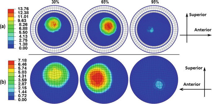 A set of two contours of the contact pressure of ratio 1. A has 3 contours of the inner contact pressure of 30 percent, 65 percent, and 95 percent. B has 3 contours of the outer contact pressure of 30 percent, 65 percent, and 95 percent.