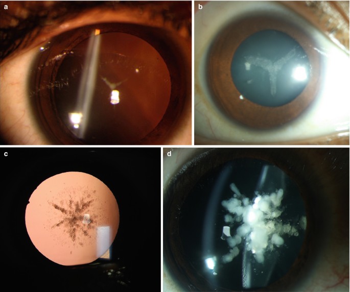 Morphology of Pediatric Cataract | SpringerLink