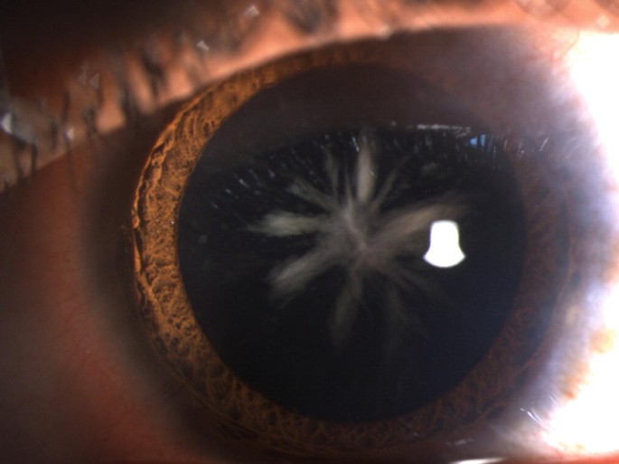 Morphology of Pediatric Cataract | SpringerLink