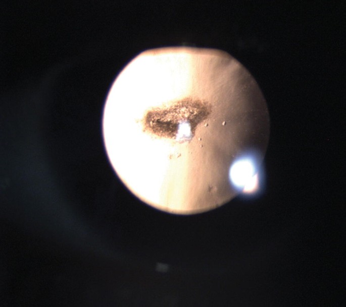 Atlas Entry - Anterior capsular phimosis