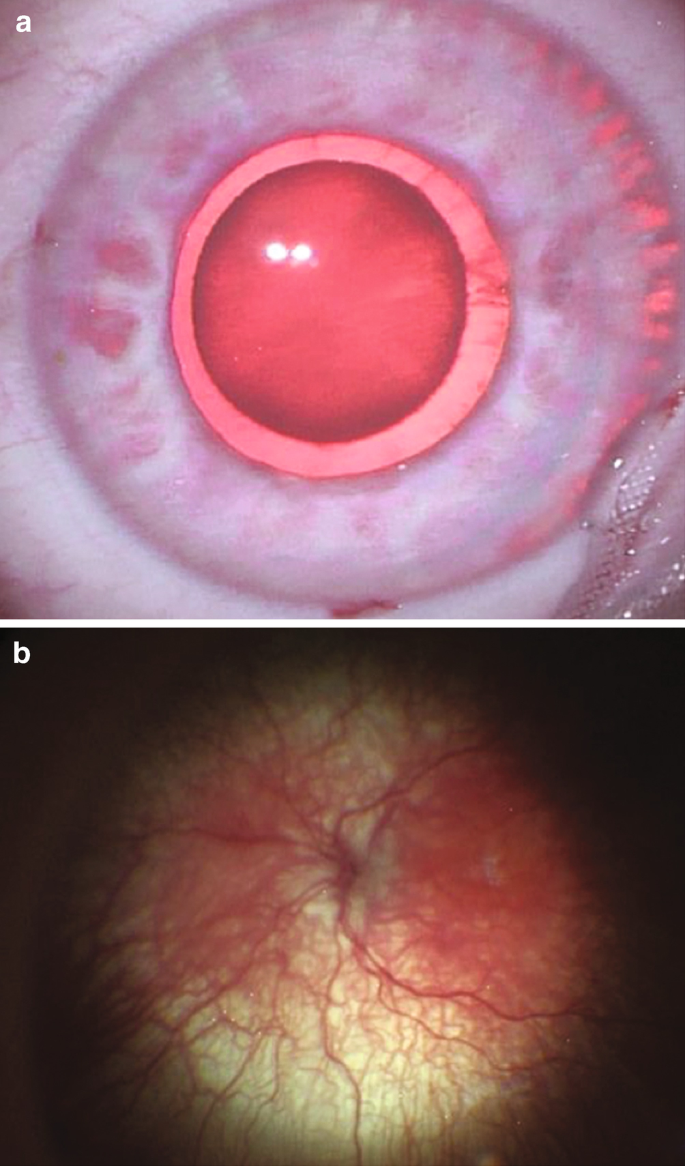 Atlas Entry - Anterior capsular phimosis