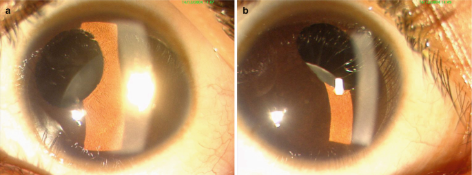 Atlas Entry - Anterior capsular phimosis