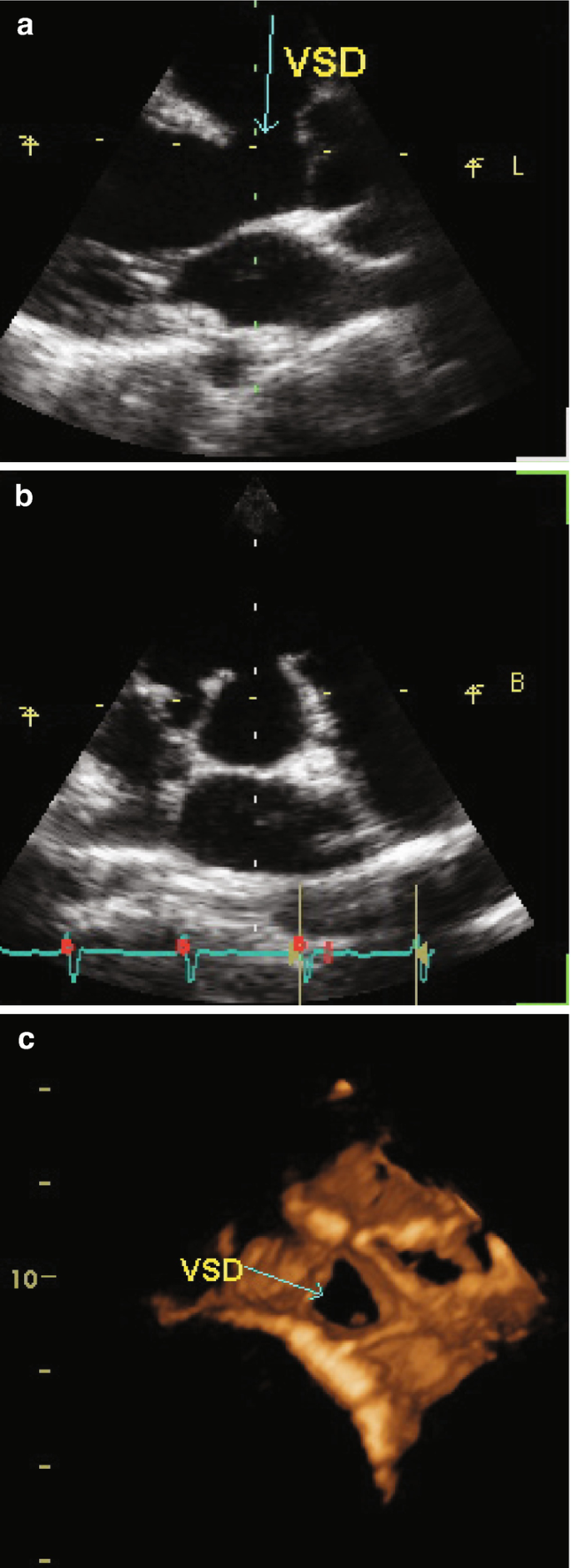 Ventricular Septal Defect (VSD) | SpringerLink