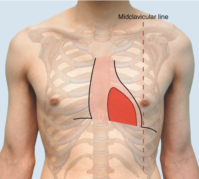 Bell-shaped chest resulting from insufficient intercostal muscle