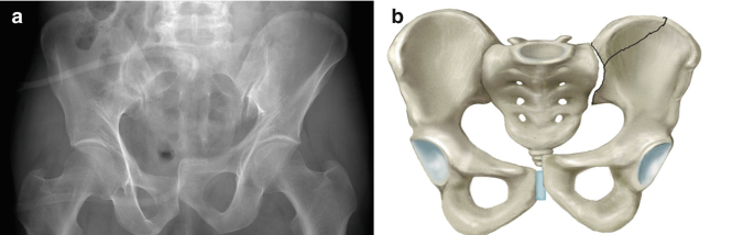 Posterior Pelvic Ring Fractures of the SI Joint and the Sacrum