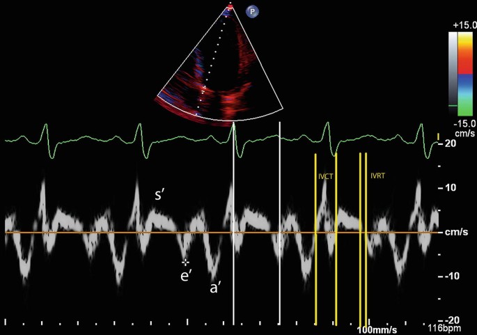 A Clinician's Guide to Tissue Doppler Imaging