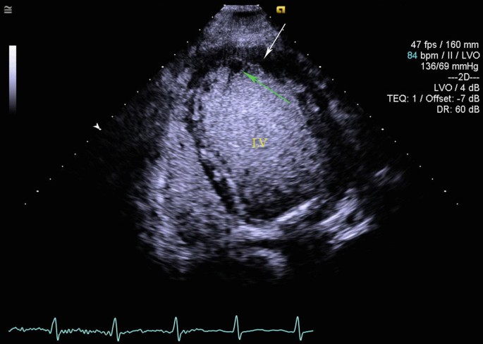 Contrast Echocardiography in Critical Care