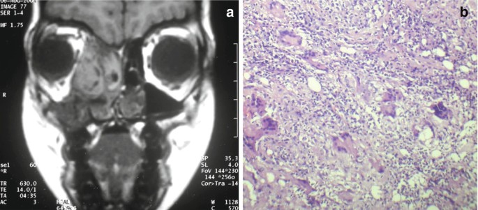 Fungal Rhinosinusitis Springerlink